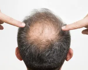 防脱生发——脱发人群和年龄分布